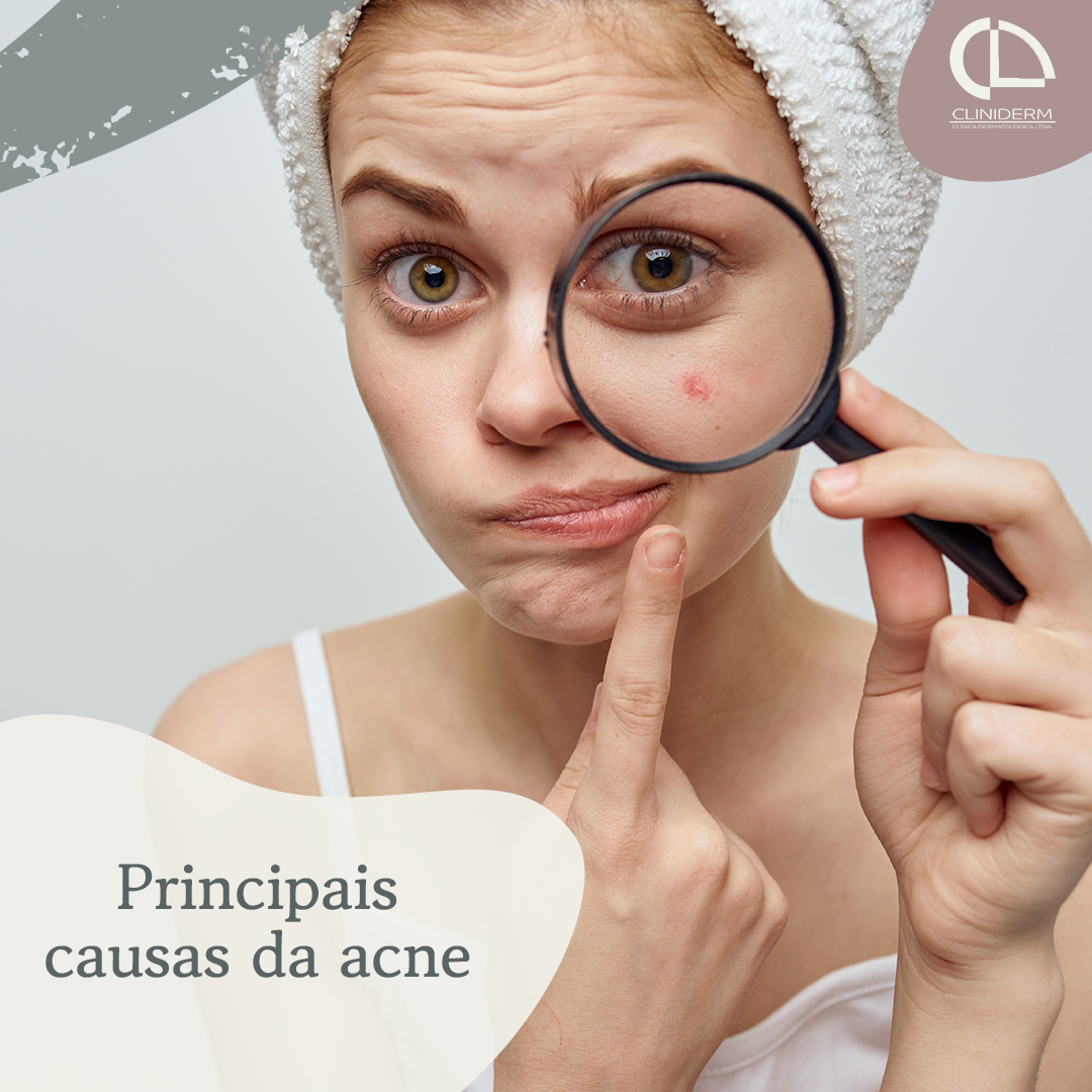 Pele com acne? Conheça as suas causas e cuidados